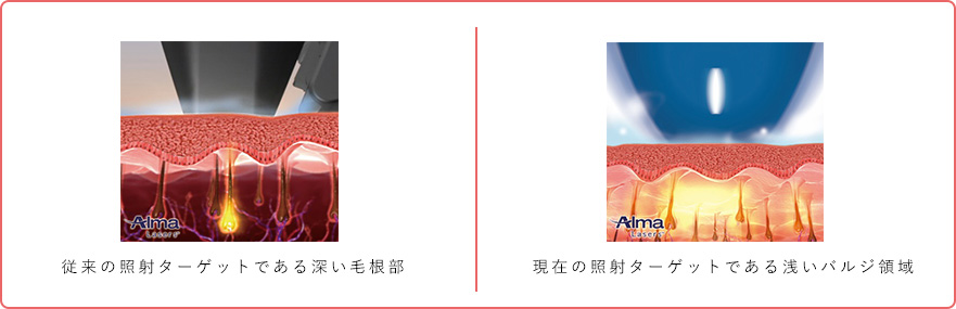 皮膚内の浅い位置にある「バルジ領域」がターゲット