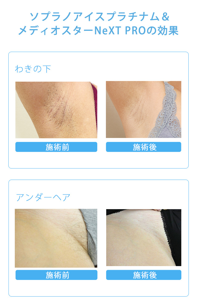 ソプラノアイスプラチナム＆メディオスターNeXT PROの効果